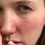 Weak, Damaged, or Sensitive Skin Barrier