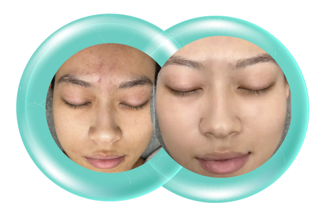 CEL Oxygenic E-Before After 2